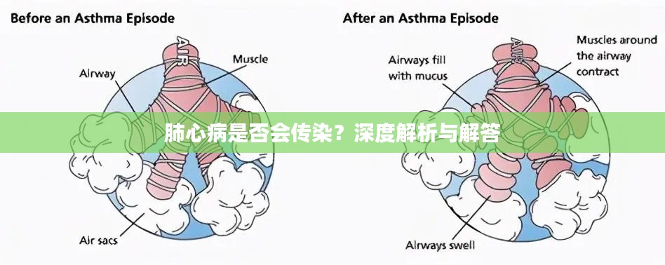 肺心病是否會傳染？深度解析與解答